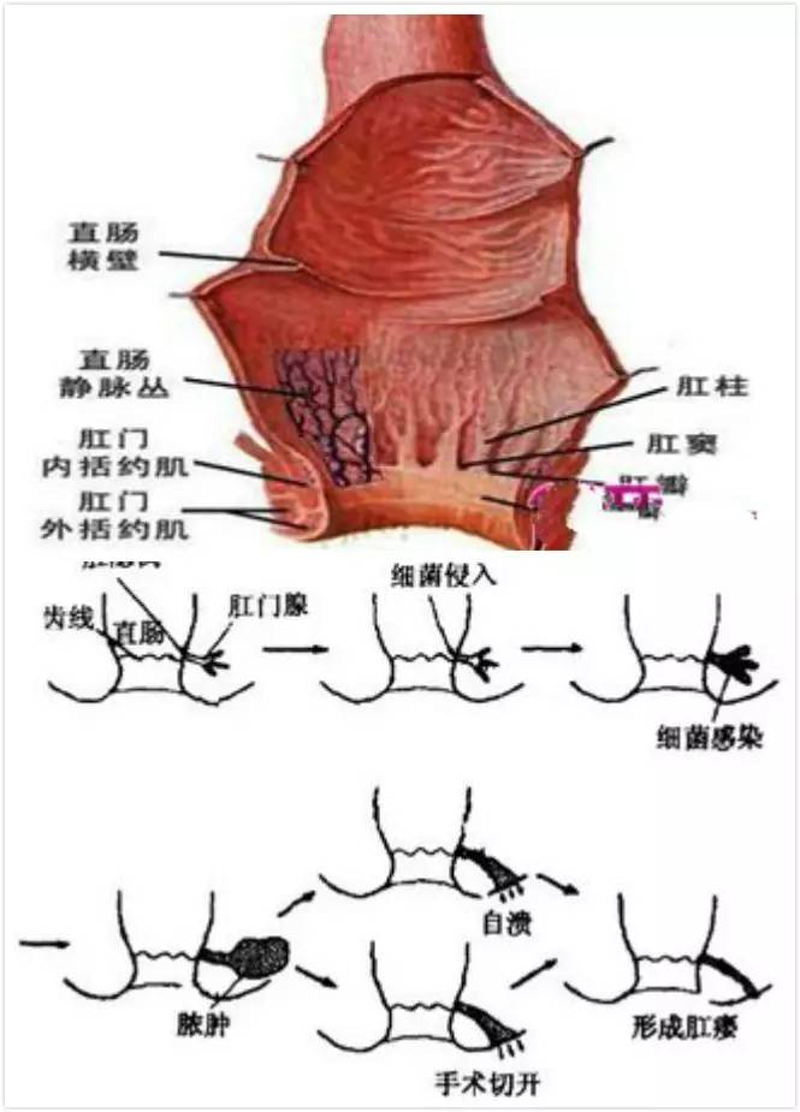 肛周脓肿